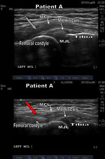 Figure 5b. Patient A ultrasounds Before and After. Top: Before AD-SC. Medial aspect of the knee. Segmented arrows showing hypoechoic medial collateral ligament at its insertion.