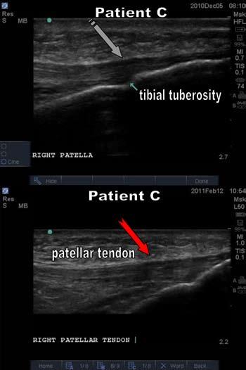 Figure 5d. Patient C ultrasounds Before and After. Top: Before AD-SC. Long view. Segmented arrow showing a long image of a hypoechoic patellar tendonitis at the insertion. Bottom: After AD-SC.