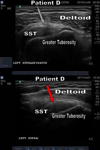 Figure 5f. Patient D ultrasounds Before and After. Top: Before AD-SC (left). Segmented arrow showing a high grade tear of the supraspinatus at its insertion.