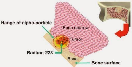 Radionuclides are an accepted part of cancer treatment Radium was investigated as a targeted treatment for bone disease due to its chemical similarity with calcium Radium is readily available