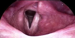 Vocal fold scarring Causes: trauma surgical treatment inflammation post infection injury