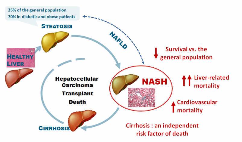 Pathophysiology of NASH Inflammation plays a key role in the pathogenesis of NASH as conditions like obesity are all associated with an elevated state of chronic inflammation that cause damage to