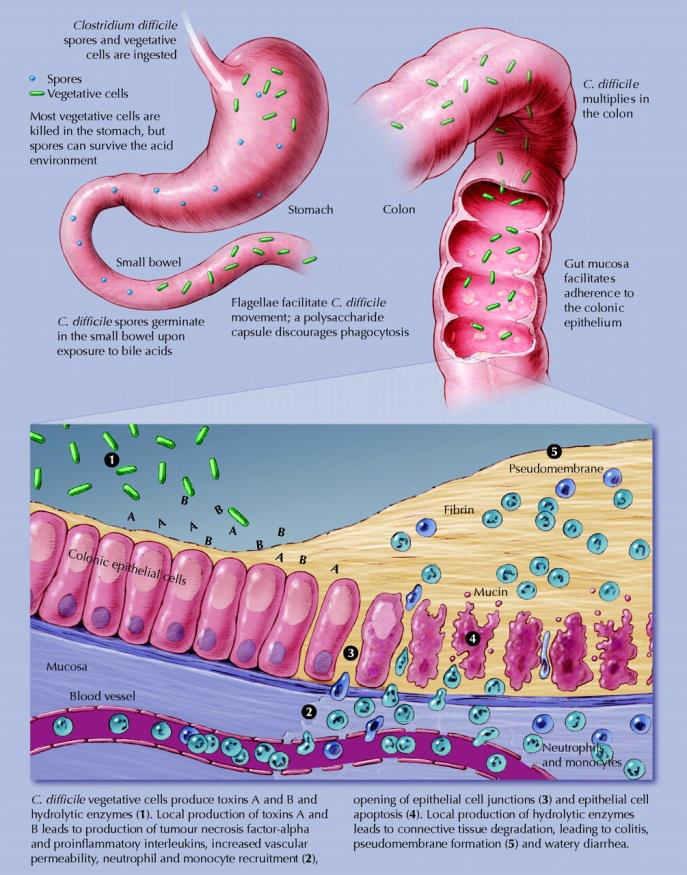 Pathophysiology of CDI Clostridium difficile (CD) is a spore-forming microorganism that releases toxins when in an anaerobic environment.