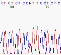 5- Heterozygous (double) peaks: A single peak position within a trace may have but two peaks of different colors instead of just one.