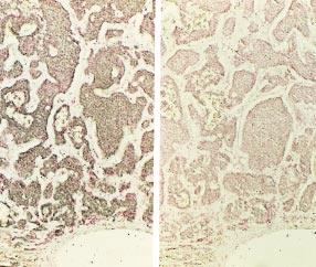hyperplasia. Panel A: PTH mrna is marked by red precipitates. Panel B: Only weak signals are present when a sense PTH probe is used as a control.