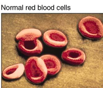 cell anemia