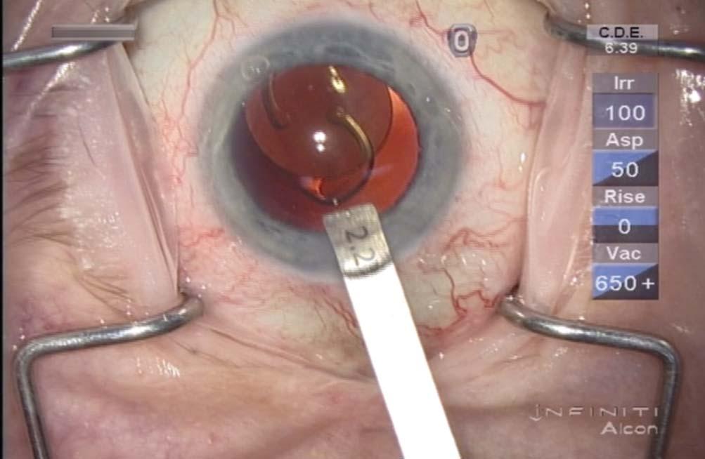 Surgeons have now been given a fully integrated phacoemulsification system to perform micro-incision cataract surgery that will inevitably improve patient outcomes. Terry Kim, M.D.