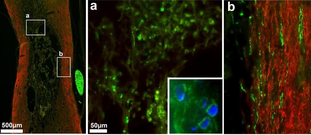 Neural Regeneration and Remyelination with Schwann Cells after Neuro-Spinal Scaffold