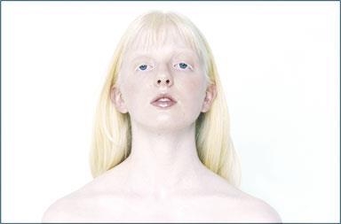 Recessively inherited disorder: albinism http://www.