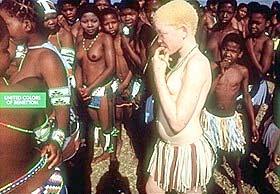 Albinism