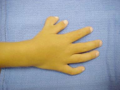 Polydactyly individuals are born with extra fingers or toes