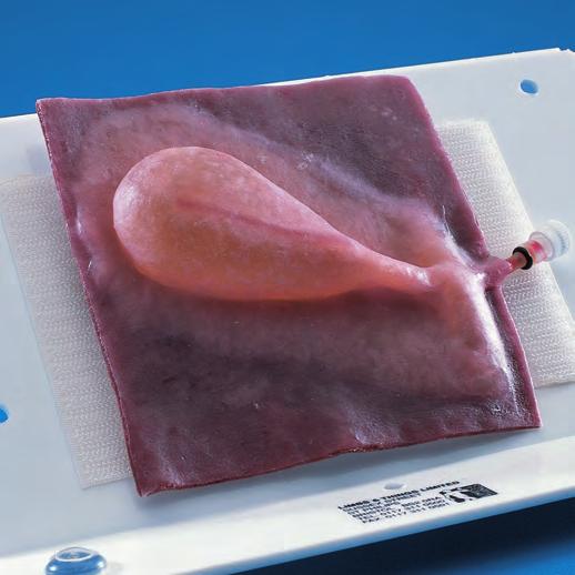 Gall Bladders A series of four highly realistic models of increasing complexity for structured and staged training in gall bladder removal.
