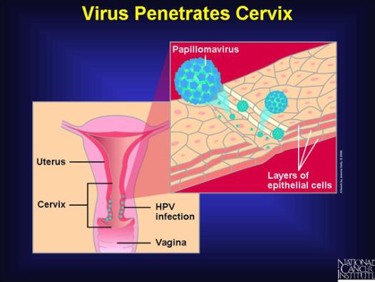 of sexually active persons will be infected with genital HPV at some time in their lives.