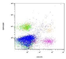 Lymph Node with Chronic Lymphocytic Leukemia/Small Lymphocytic Lymphoma 0 1023 CD45 Kro This CD45 x Side Scatter dot plot demonstrates both normal T lymphocytes (green) and a large population of