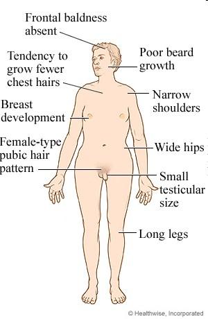 Chromosomal Abnormalities some examples Errors sometimes occur during meiosis Down Syndrome