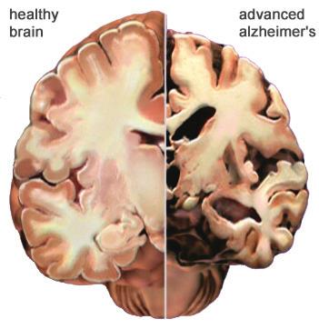Neurodegenerative Diseases and Disorders (just to name a few) Parkinson s Disease 1.