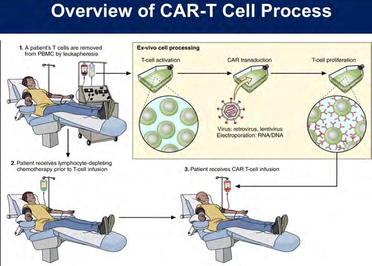 Figure 6: Overview of CAR-T Cell Process CAR-T Therapy for Acute Lymphoblastic Leukemia: Anti-CD19 chimeric antigen receptor (CAR) T-cells are the first FDA-approved cellular immunotherapy, and they