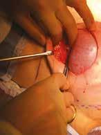 STEP 8: Suture Meso BioMatrix scaffold to the inframammary fold using a PDS or vicryl suture.