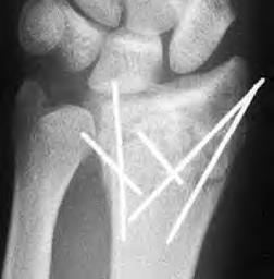 Orthopedic Pins Orthopedic pins and screws are