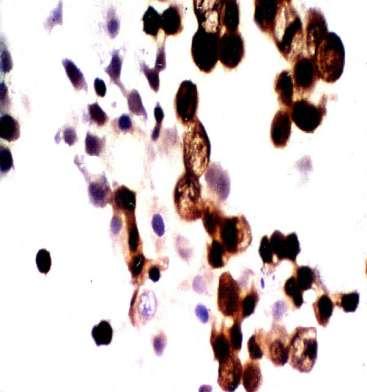 Tube culture positive for HSV-1. HSV-1 infected cells (stained dark brown).