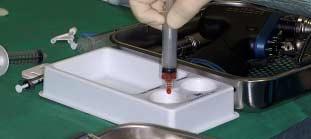 Preparation of Platelet-Rich Plasma (PRP) gel. The procedure is continued in the sterile field 1.