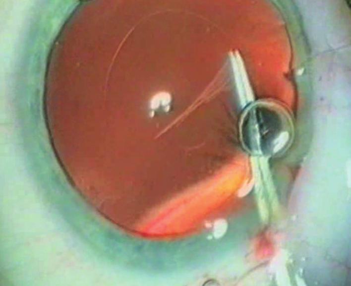 placed in the capsular bag and remain there. During the course of preparing for the Binkhorst Lecture, I.