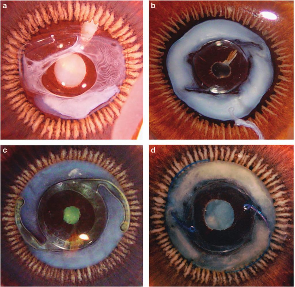 4 New hydrophilic acrylic supplementary IOL Figure 2 Posterior Miyake-Apple views of four eyes included in this study, displaying the variety of IOL type and Soemmering s ring severity.