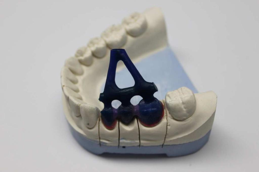 patients that are missing teeth. When choosing the technology for fixed dental structure manufacturing, three viable options are available (precise casting, milling, selective laser melting).