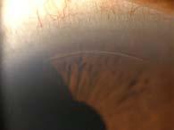 2Taban M, Behrens A, Newcomb RL, Nobe MY, Saedi G, Sweet PM, McDonnell PJ. Acute endophthalmitis following cataract surgery: a systematic review of the literature, Arch Ophthalmol. 2005;123(5):613-20.