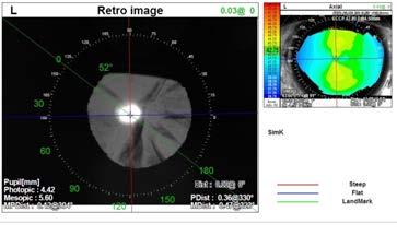 Cortical Spokes Qualifying Requirements for an IOL Patient! Refraction! Keratometry! Corneal Topography for Astigmatism! Pupillometry Photopic/Mesopic! Eye Image Visual Axis and Pupil Center!