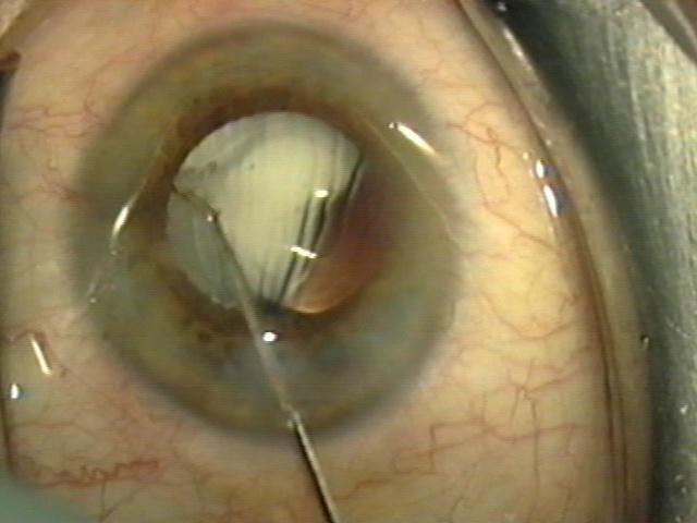 12mL is injected into the eye.