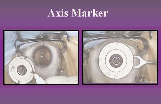 If it does not, this indicates that the axis marker has been eccentrically placed on the cornea.