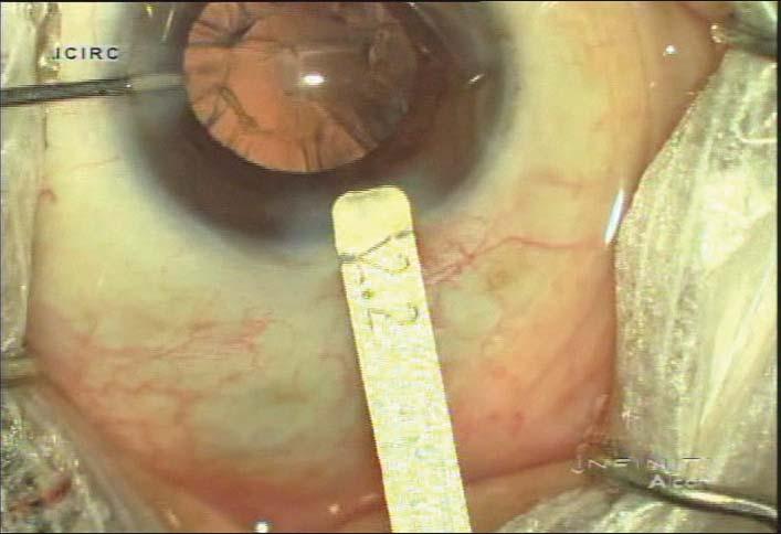 Typically, you would see a distortion at the internal entry in a dense cataract, and you d see a lot of hydration and incisional stress, but you don t with the combination of OZil and micro-coaxial.
