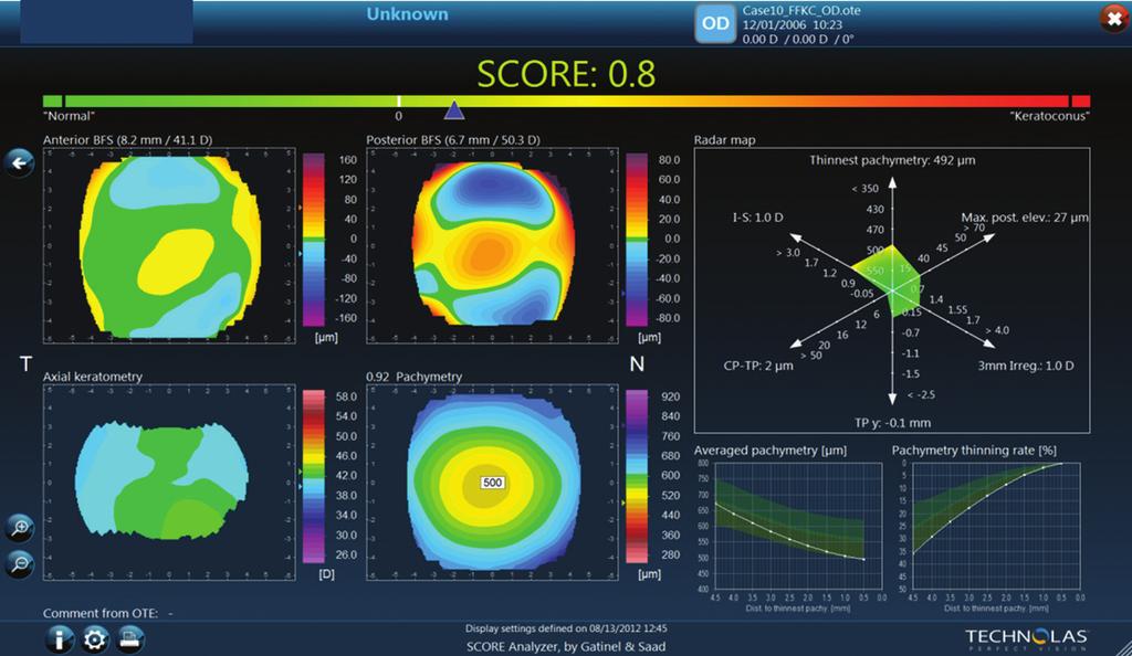 Latest Advances in Diagnostic Technologies The SCORE Analyzer and Zyoptix Diagnostic Workstation 3 are key elements of the preoperative exam for refractive surgery.