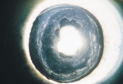 A hydrogel intraocular lens (IOL) showing a confluent scalloped lens epithelial cell membrane (small arrow) on the anterior IOL surface contiguous with the capsulorhexis (large arrow) (original