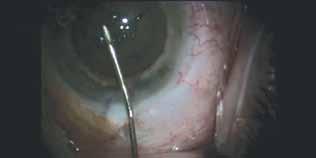 Early Adopters Experiences With Laser Cataract Surgery Incorporating laser cataract surgery into my practice was a very difficult yet correct decision. By A.