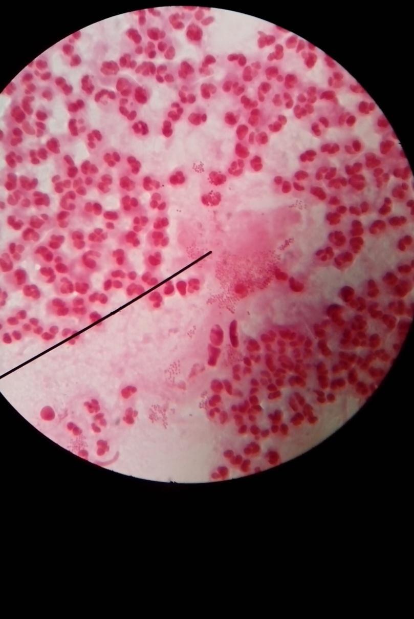Urethral smear: Gram negative diplococci with adjacent sides flattened (kidney-bean shaped) Usually found inside pus cells Intracellular in acute gonorrhea, in early infections