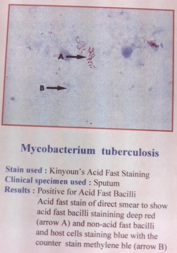 International Union Against Tb and Lung Disease Reporting Acid Fast bacilli in Sputum specimen No AFB in at least 100 fields 0 or (-) 1-9 AFB in 100 fields