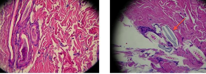 Histology A) Tissue sample of control side showing connective tissue only.
