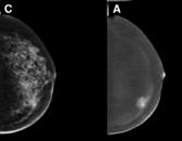 Imaging with contrast agents in breast cancer has already been described in previous magnetic resonance imaging and computed tomography studies.