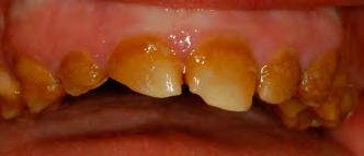 Dental Prosthodontics and Restorative Dentistry tially smoother surface than glazed ceramic.