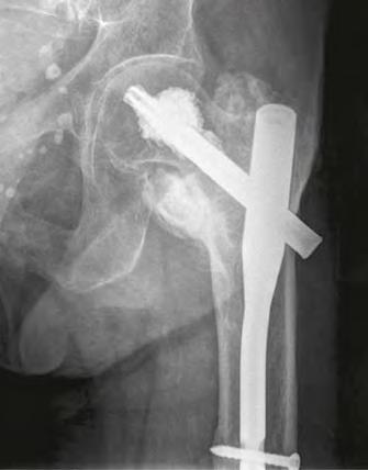 at Keywords Clinical studies, biomechanics, fracture fixation, cell biology, osteoporosis, geriatric patients Research Focus Research in the Department of Trauma Surgery focuses on the evaluation,