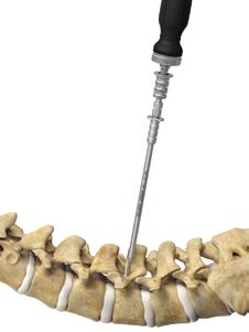 Offered in both cannulated and non-cannulated screw configurations Medial to lateral Features and benefits The Xia CT fixation system features innovative components Screw insertion points Traditional