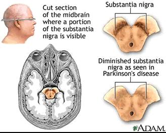 Neuronal stem cells and Parkinson Disease Neurodegenerative disease - loss of dopamine neurons Fourth