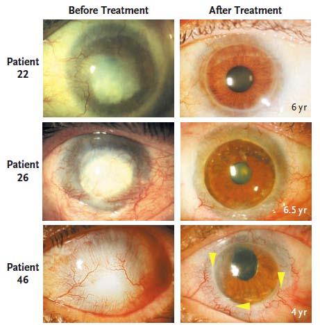 Limbal stem cells in treatment of blindess caused by damage (mostly burn-caused) The autologous limbal cells were used for the transplantation Permanent restoration of a transparent, renewing corneal