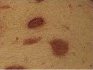 transfer to fibroblasts Positive for