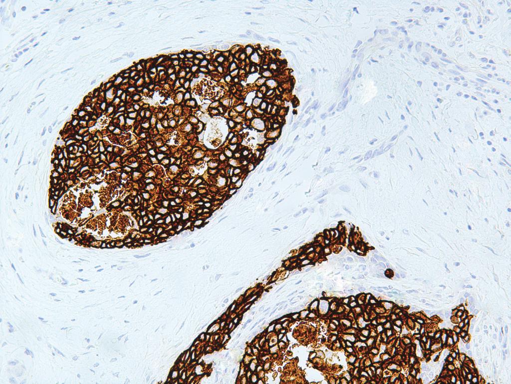 GeneAbTM Her2/Neu Clone: IHC002 Source: Mouse Monoclonal Positive Control: Breast Carcinoma 1. Intended Use This antibody is intended for in vitro diagnostic (IVD) use.