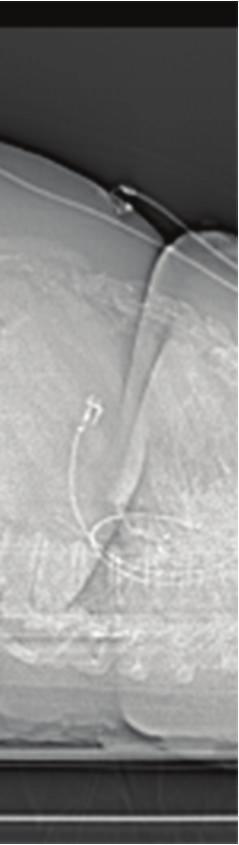 40 37 Figure 2: Thoracic stent graft (black arrows) and resolving thoracic