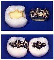 Dental Metals Gold and gold alloy: Noble metal-known since thousands of years First dental biomaterial Biocompatible Pure gold is to soft for dental