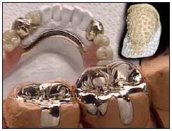 Dental Metals Alloys Ca.